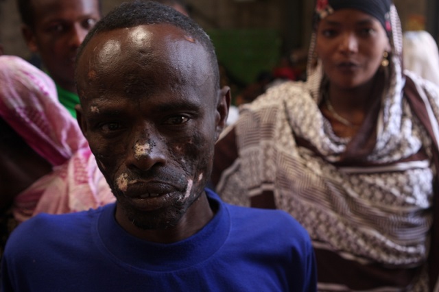One of the Ethiopians who have been victims of ethnic violence